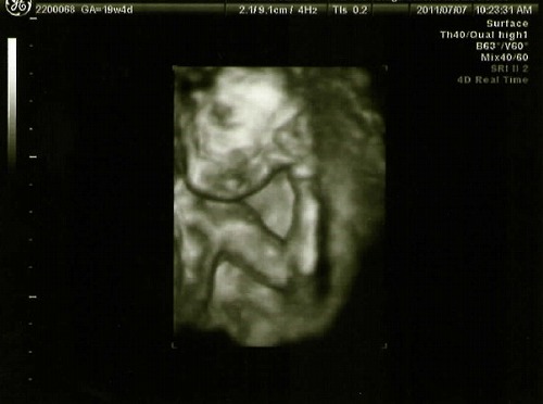 妊娠5ヶ月 妊娠19週目 胎児スクリーニングと痒み止め 不育症母ちゃんの親バカ育児