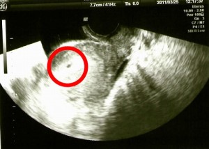 妊娠4週5日のエコー写真