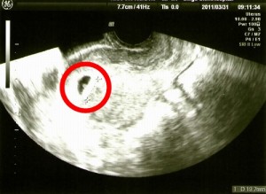妊娠5週4日の時のエコー写真